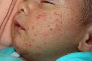 Как проявляется аллергия у детей?