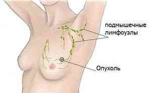 Первые признаки рака молочной железы