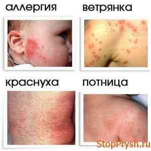 У заболевания потница симптомы похожи на аллергию или диатез