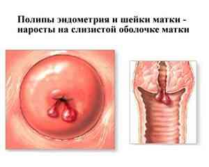 Полипы в матке: полипы эндометрия и полипы шейки матки